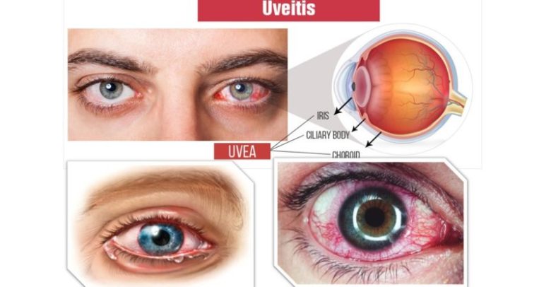 Vitreo-Retinal & Uveitis Services